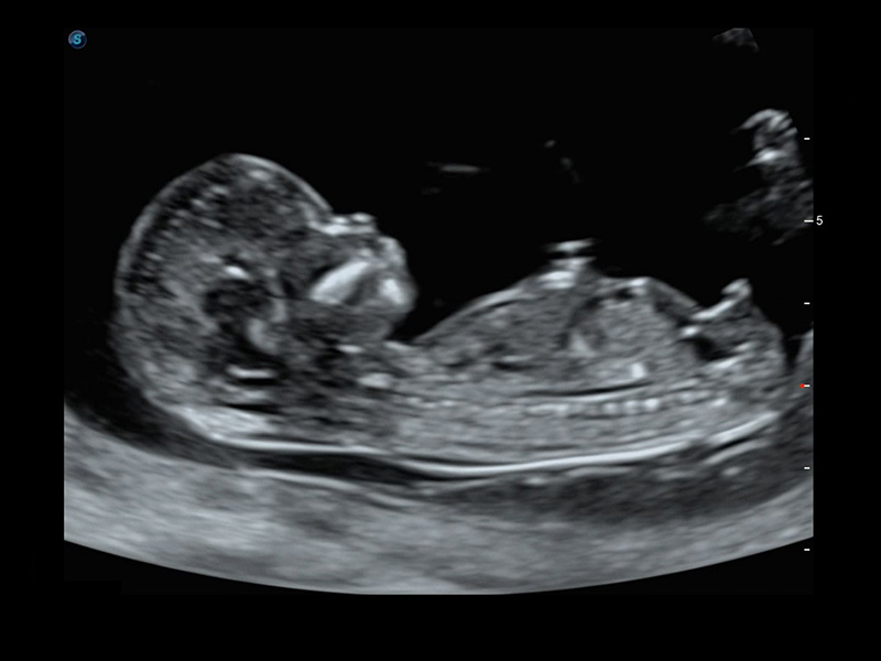USG prenatalne